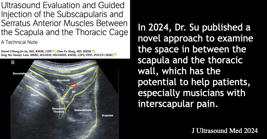 Annotated ultrasound image showing subscapularis and serratus anterior between the scapula and thoracic wall, from Dr. Su's 2024 technical note